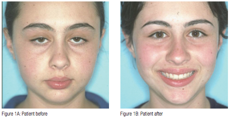 Bombs correcting facial muscle banding frank