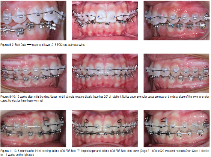 Braces Wire Size Chart