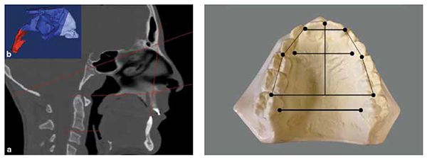 Figure 1: 2.36% volumetric increase for each mm of expansion (Reprinted with permission of Dr. Melih Motro); Figure 2