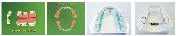 Figures 12-14 (Used with permission of Dr. German Ramierz); Figure 15: Screw linear transverse expander