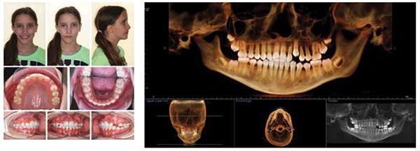 Figure 16: Interim deband photos show improvement in dental midlines and facial symmetry; Figure 17: Interim deband panoramic image