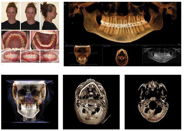 Figure 20: Diagnostic photos of a 27-year 6-month-old female with a history of a left subcondylar fracture at age 5; Figure 21: Panoramic CBCT imaging demonstrating a gross difference in the size between the right/left ramuses and condyles; Figure 22: Frontal CBCT image illustrating left-sided skeletal asymmetry; Figure 23: Axial CBCT image revealing severe difference in size and shape of the inferior border of the mandible; Figure 24: Sectional CBCT image at the level of the condyles. Note the significantly misshapen and displaced left condylar head