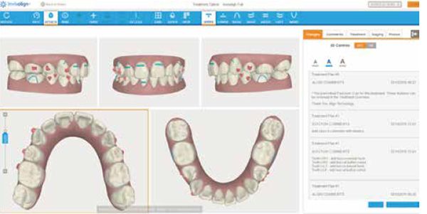 aligner_shipley_propel_fig10