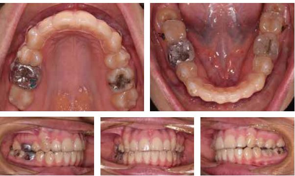 aligner_shipley_propel_fig13-17