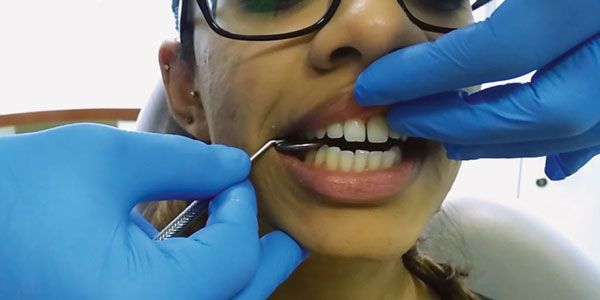 tmj dysfunction clicks and trismus ce articles trismus