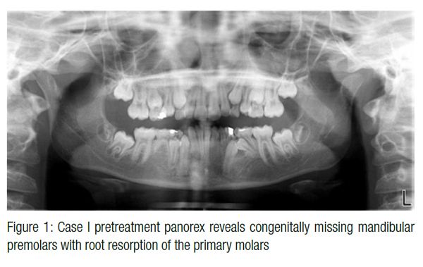 the panorex figure 1 revealed that the developing first premolars had resorbed the mesial root of the primary second molars on both sides